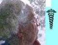 2nd Alzheimers Symptom - Learn all about alzheimers and its symptoms.